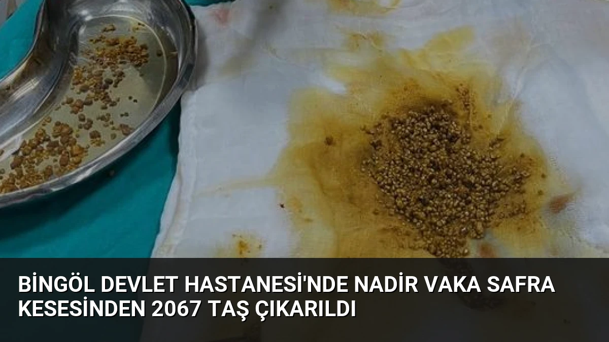 Bingöl Devlet Hastanesi’nde Nadir Vaka Safra Kesesinden 2067 Taş Çıkarıldı
