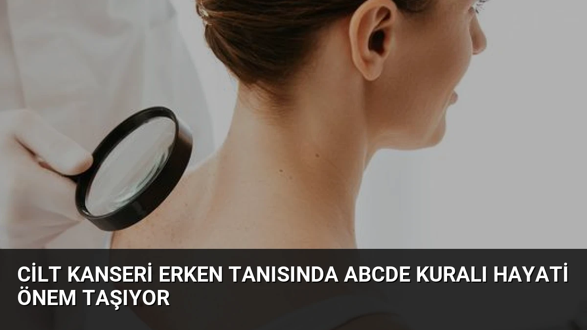 Cilt Kanseri Erken Tanısında ABCDE Kuralı Hayati Önem Taşıyor