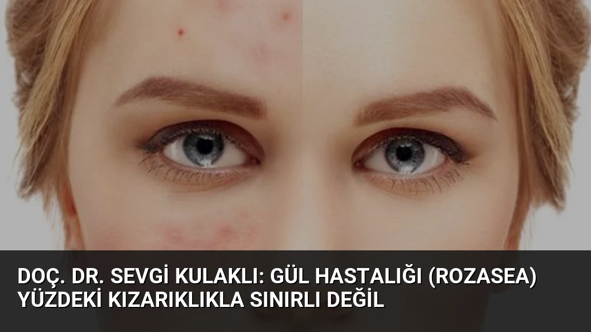 Doç. Dr. Sevgi Kulaklı: Gül Hastalığı (Rozasea) Yüzdeki Kızarıklıkla Sınırlı Değil