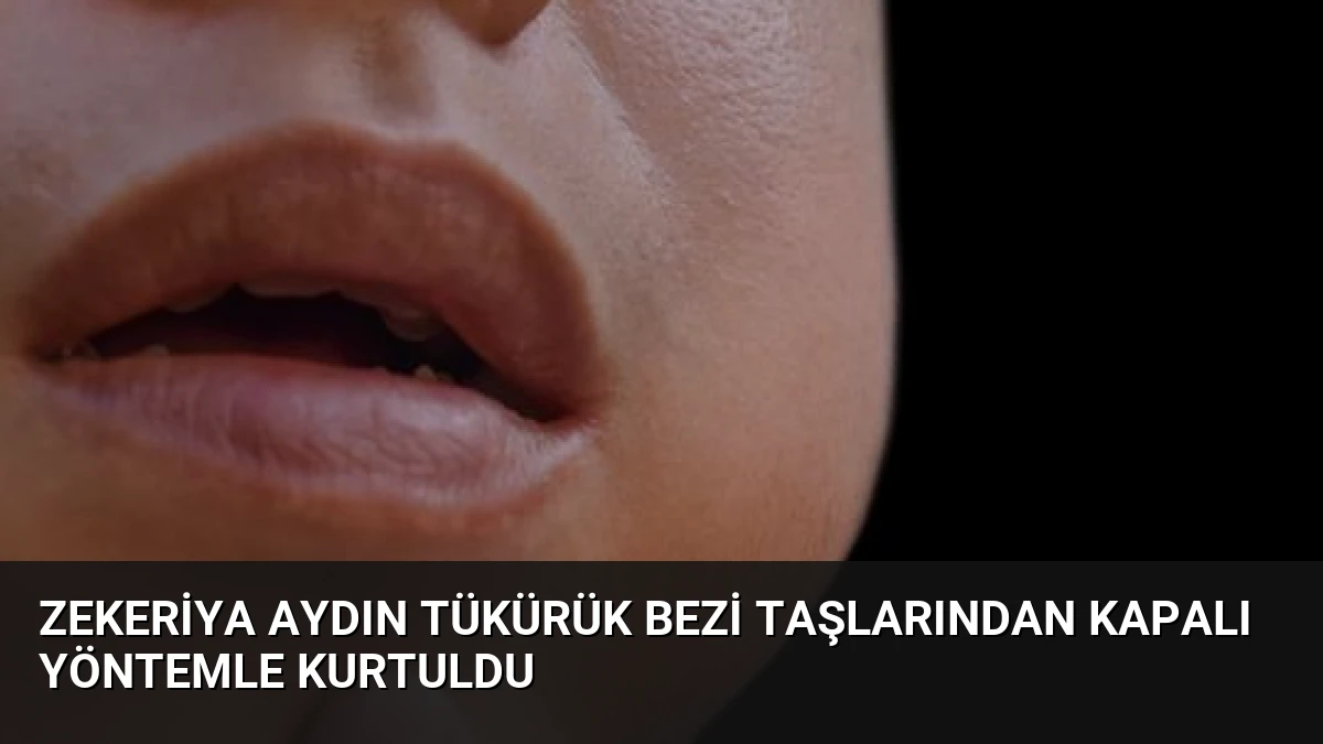 Zekeriya Aydın Tükürük Bezi Taşlarından Kapalı Yöntemle Kurtuldu